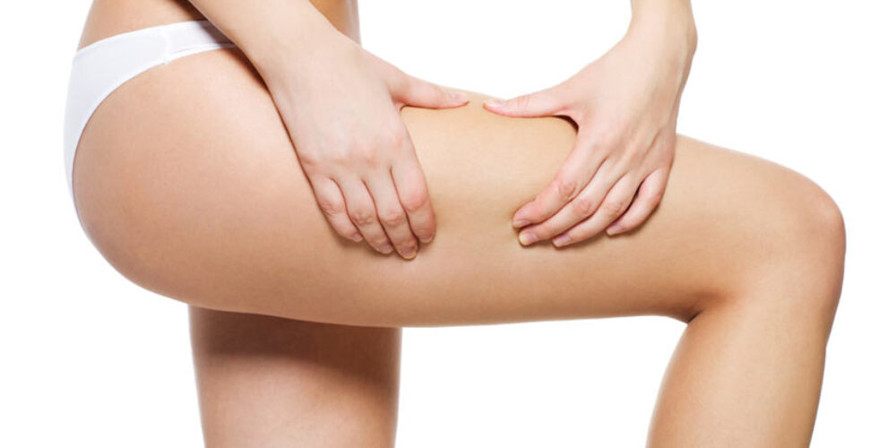 Cellulite