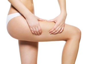 Read more about the article Cellulite