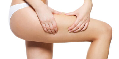 Cellulite